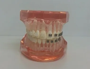 ブラケット矯正