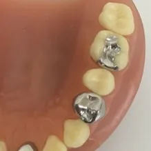 保険適用の詰め物・被せ物