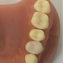 保険適用外の詰め物・被せ物