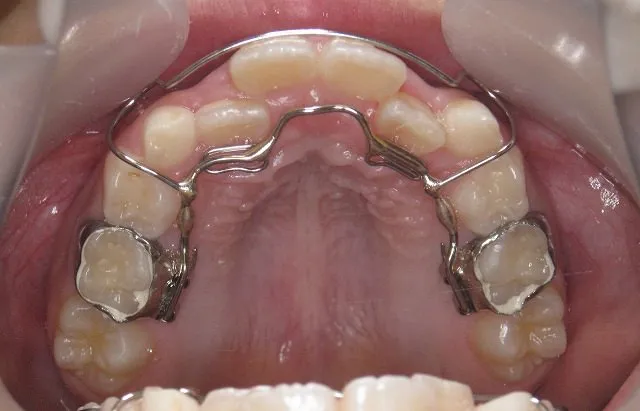 リンガルアーチ