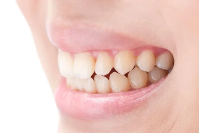 噛み合わせ治療